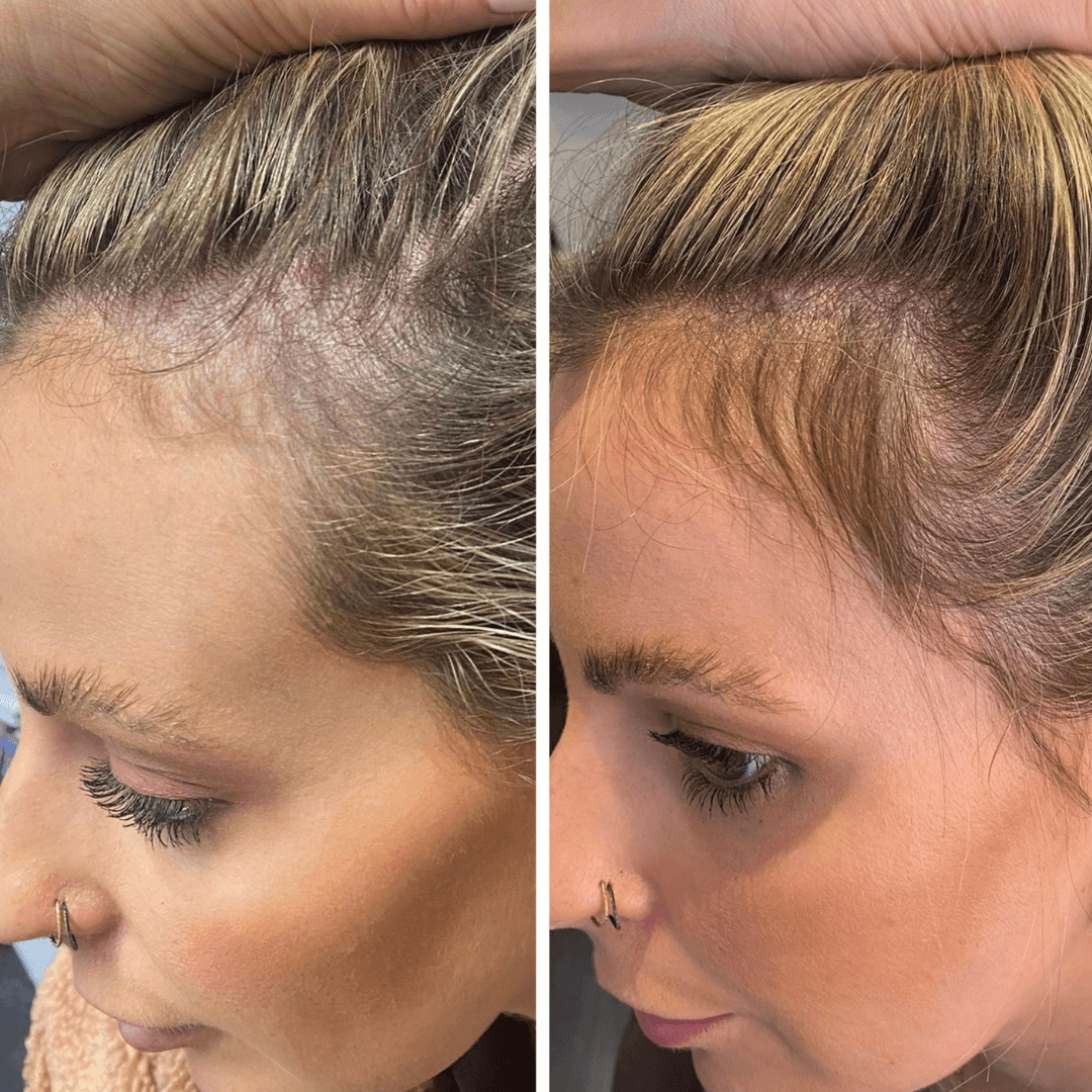 Before and after image for hair growth helmet for thinning hair and scalp health