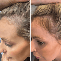 Before and after image for hair growth helmet for thinning hair and scalp health